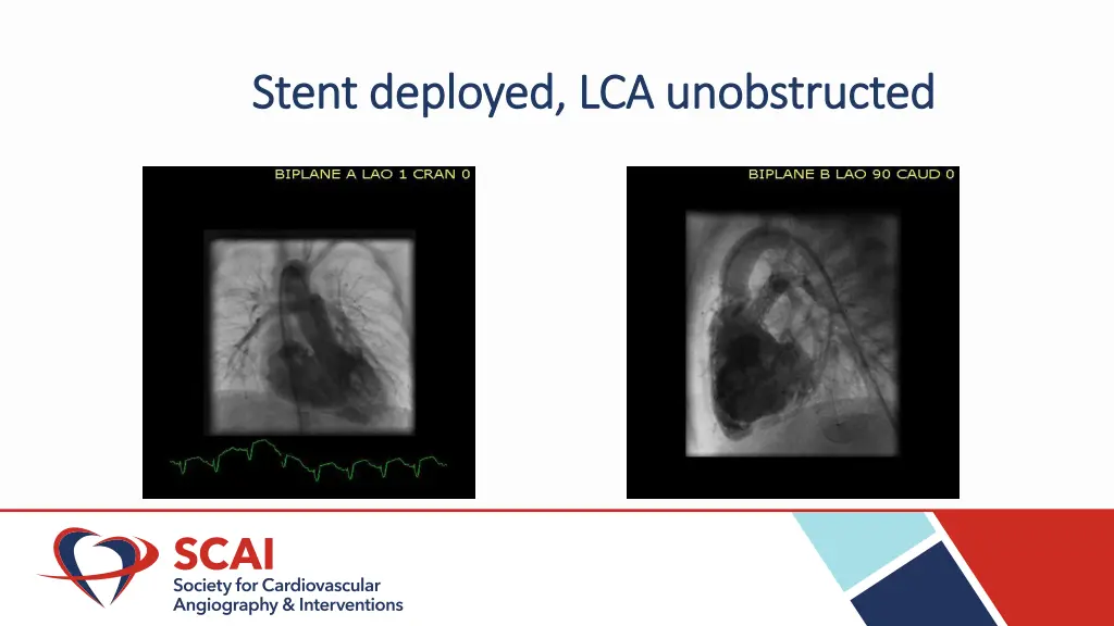 stent deployed lca unobstructed stent deployed