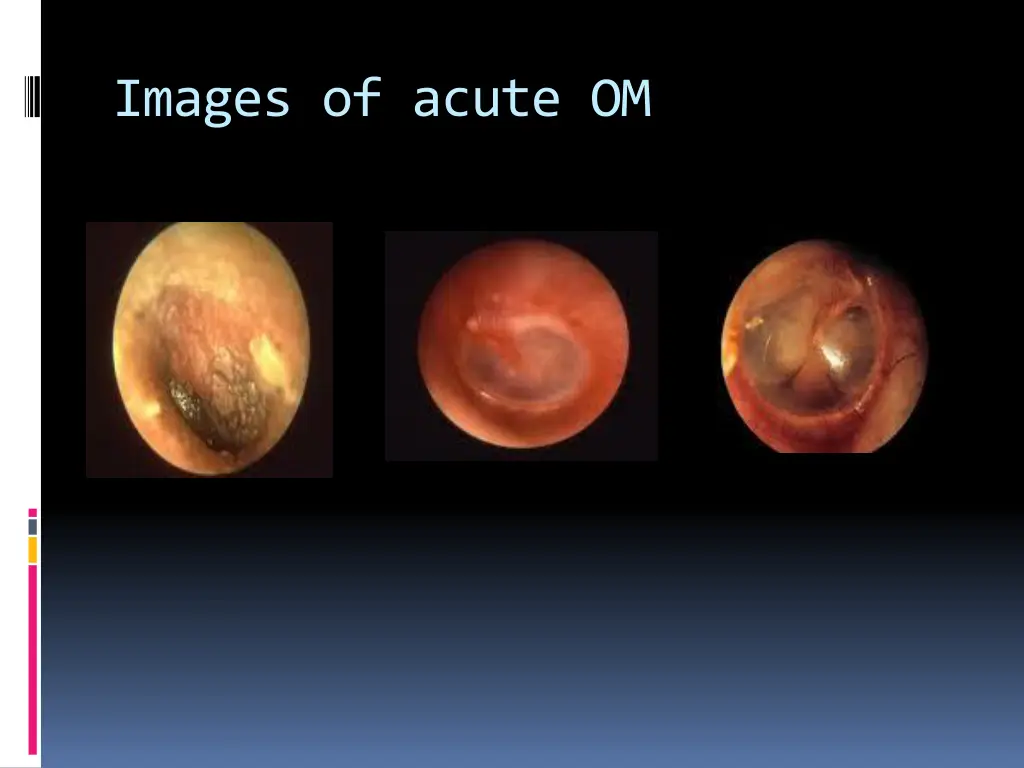 images of acute om