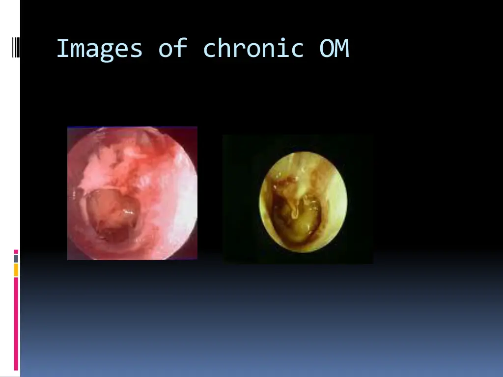 images of chronic om