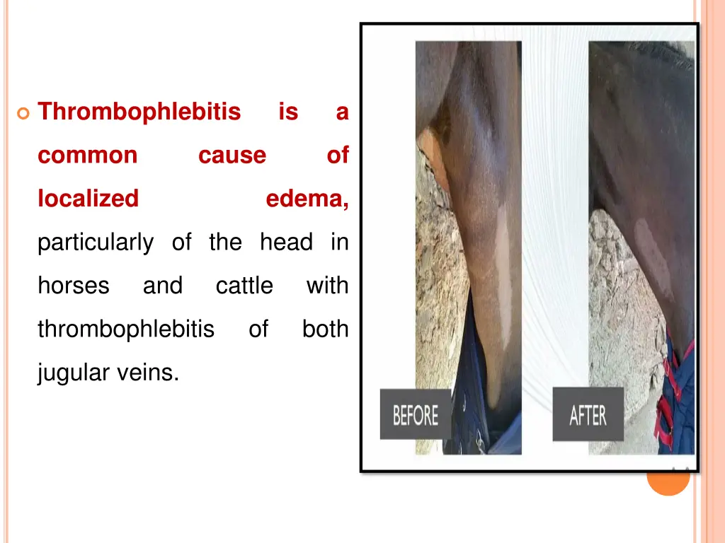 thrombophlebitis