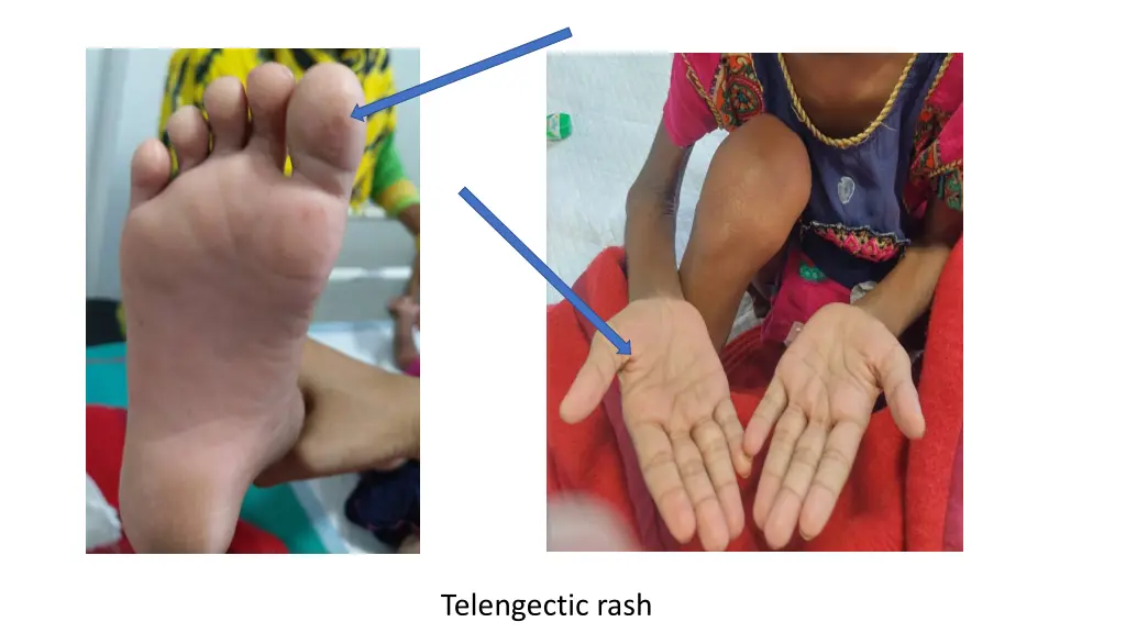 telengectic rash