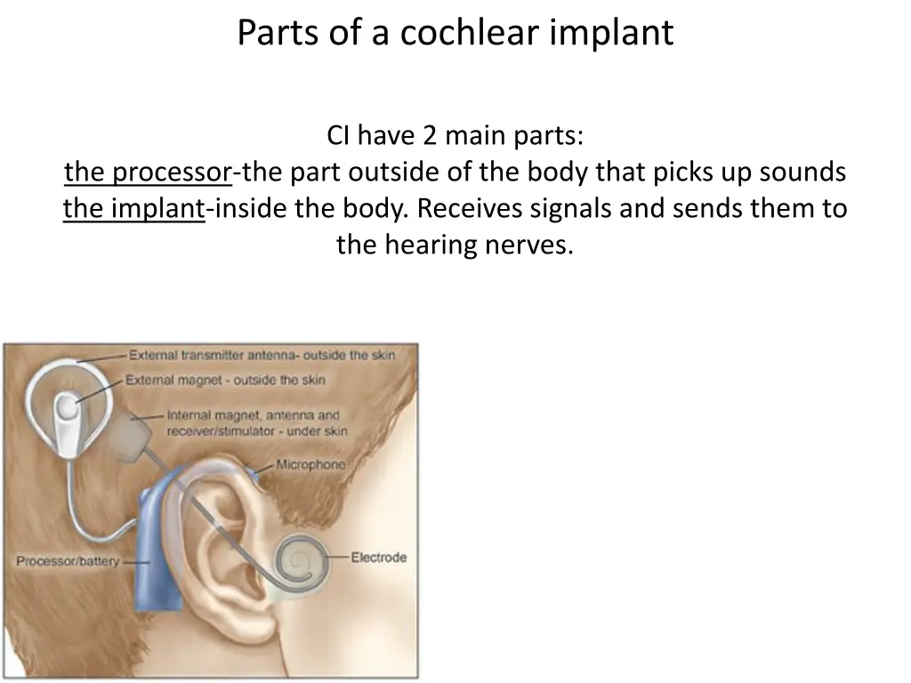 parts of a cochlear implant