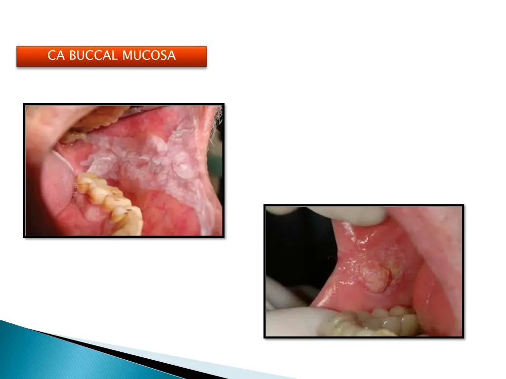 ca buccal mucosa