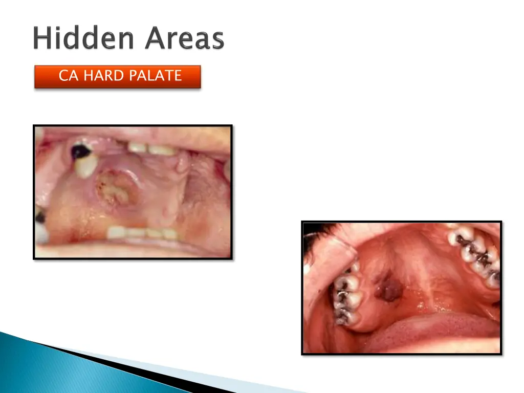 ca hard palate