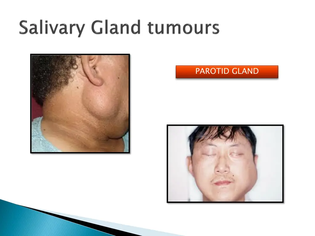 parotid gland