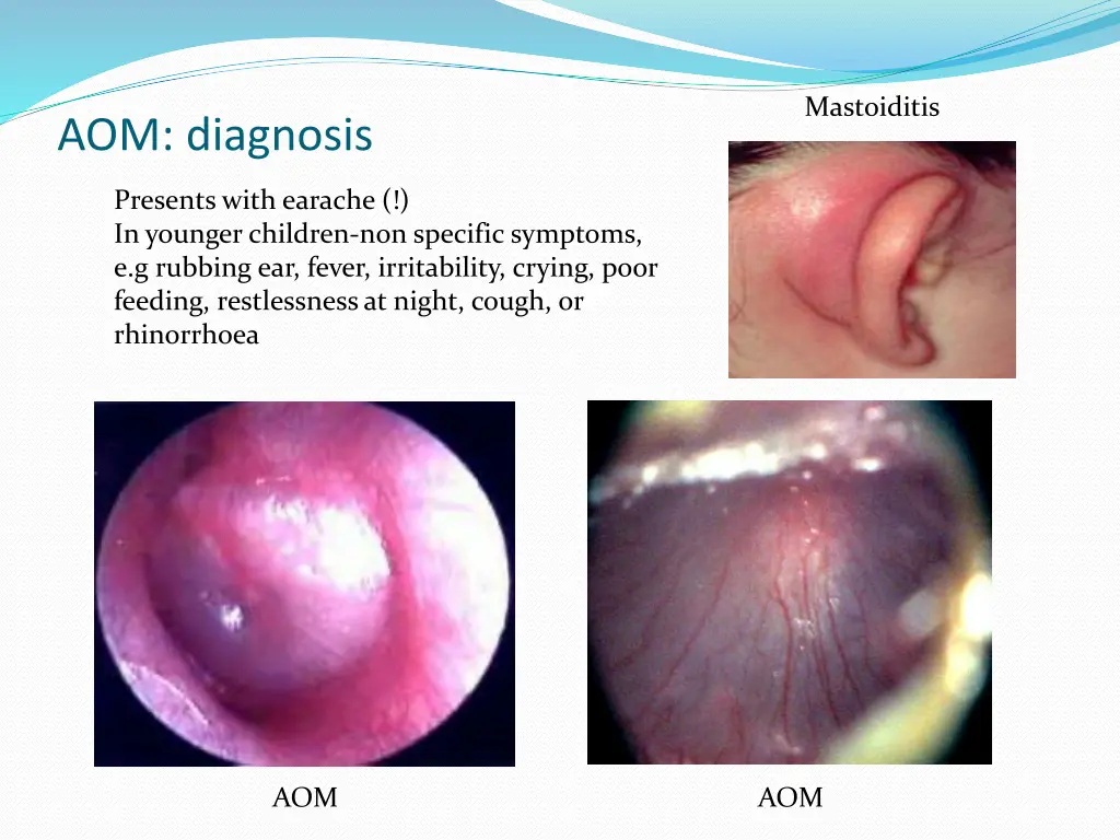 mastoiditis