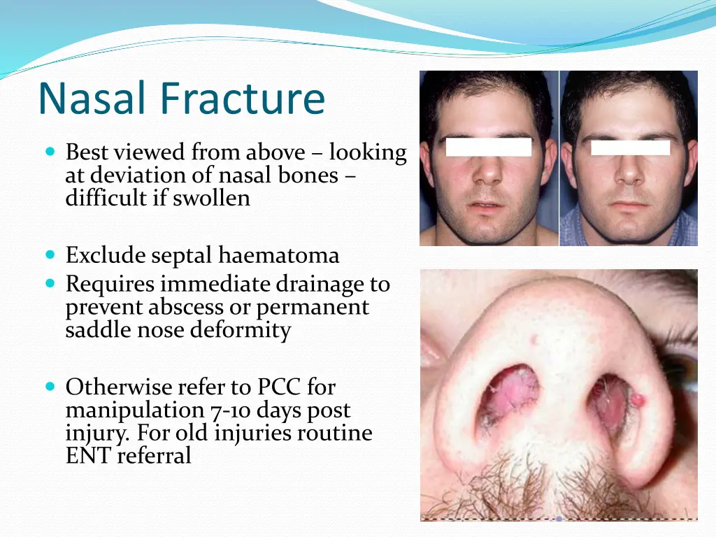 nasal fracture