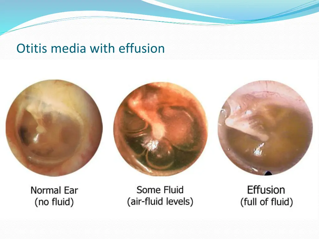 otitis media with effusion