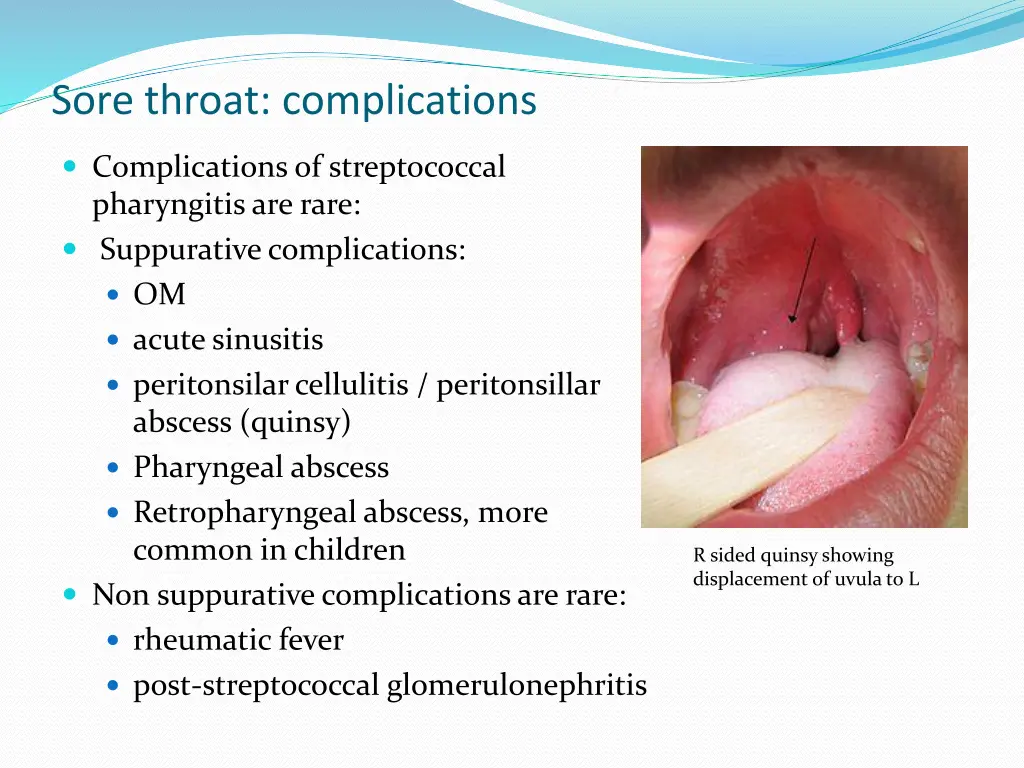 sore throat complications