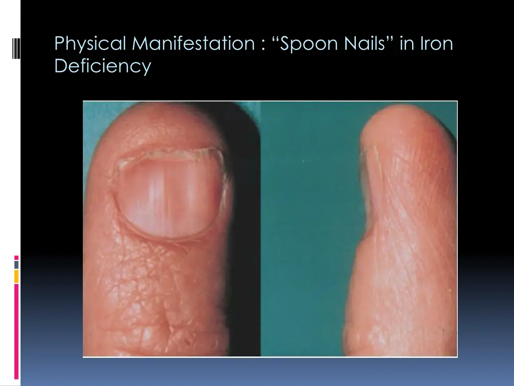 physical manifestation spoon nails in iron