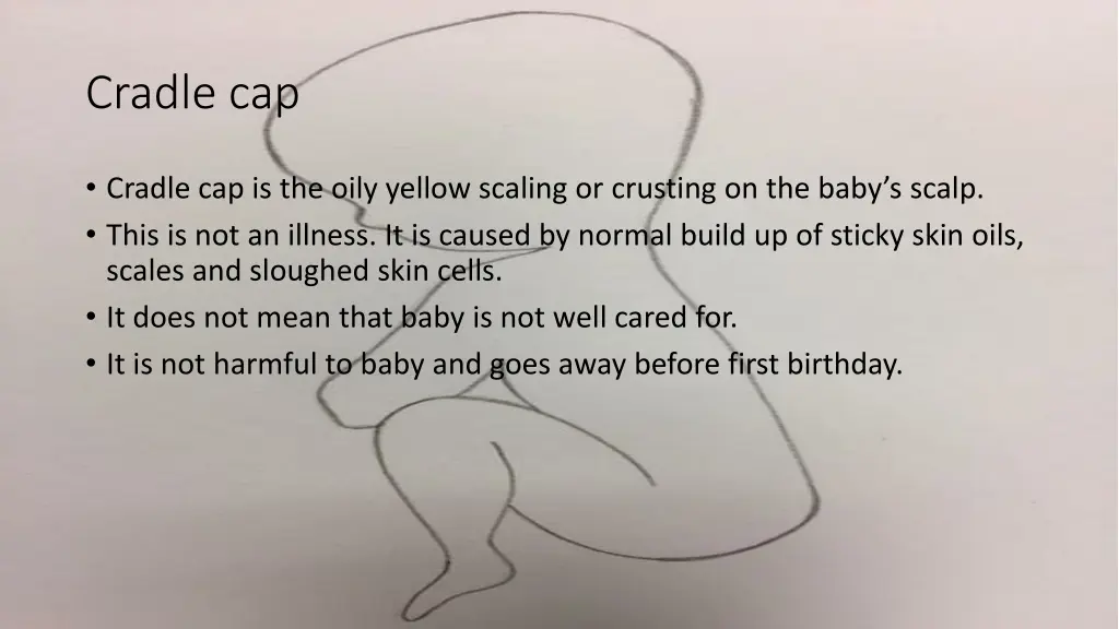 cradle cap