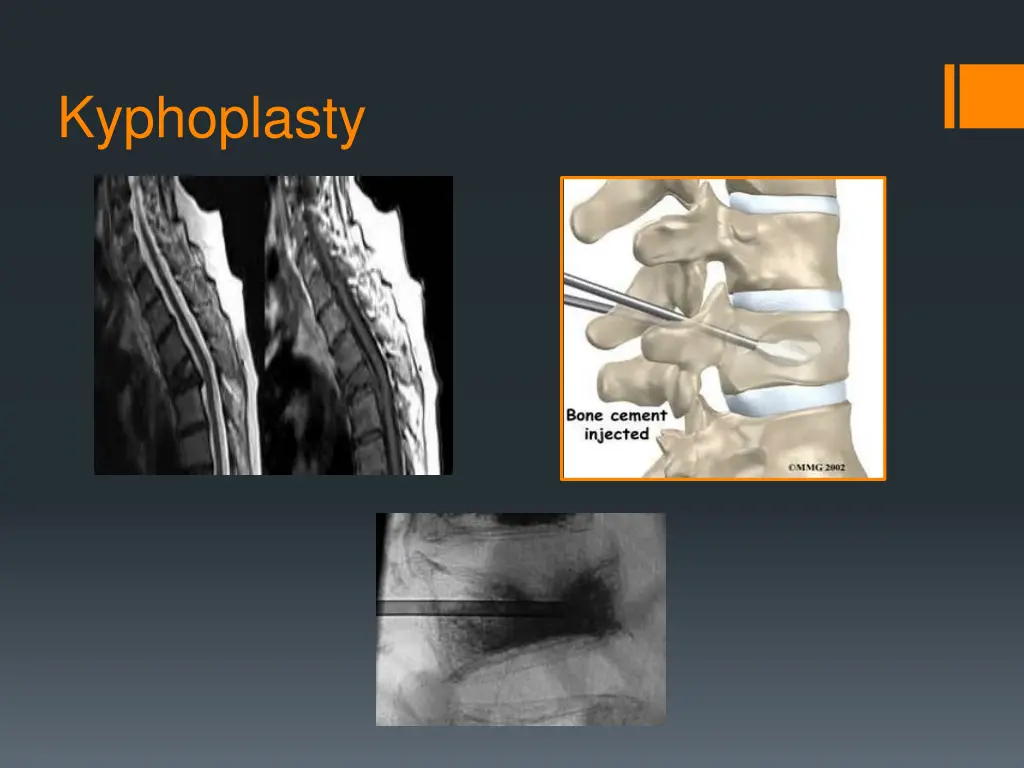 kyphoplasty