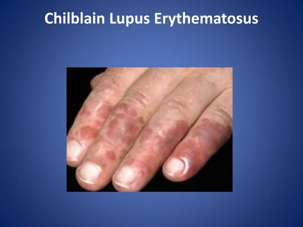 chilblain lupus erythematosus 1