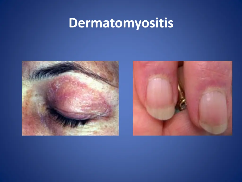 dermatomyositis 2