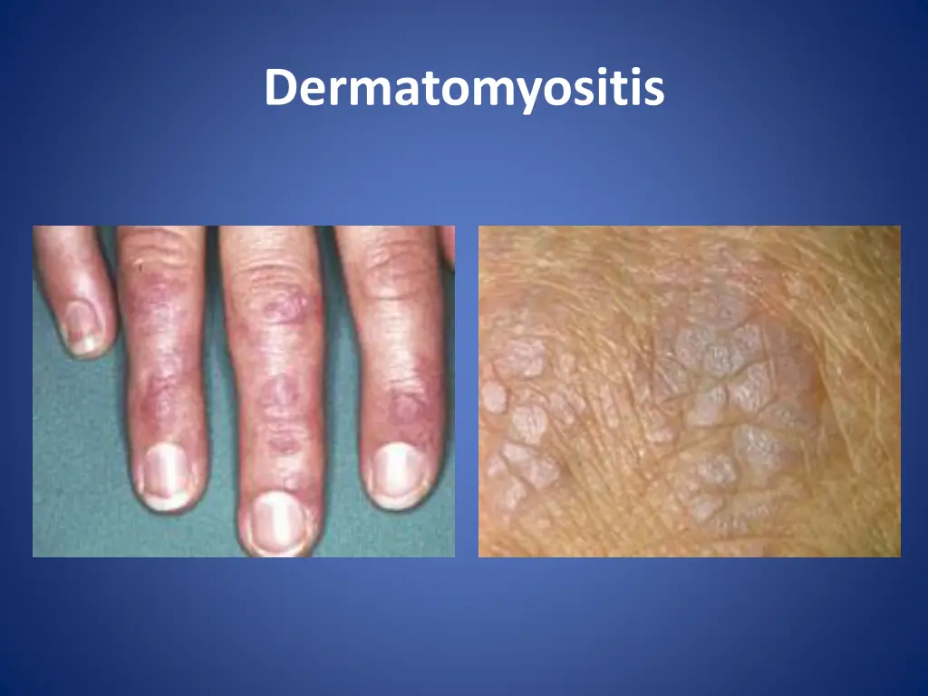 dermatomyositis 3