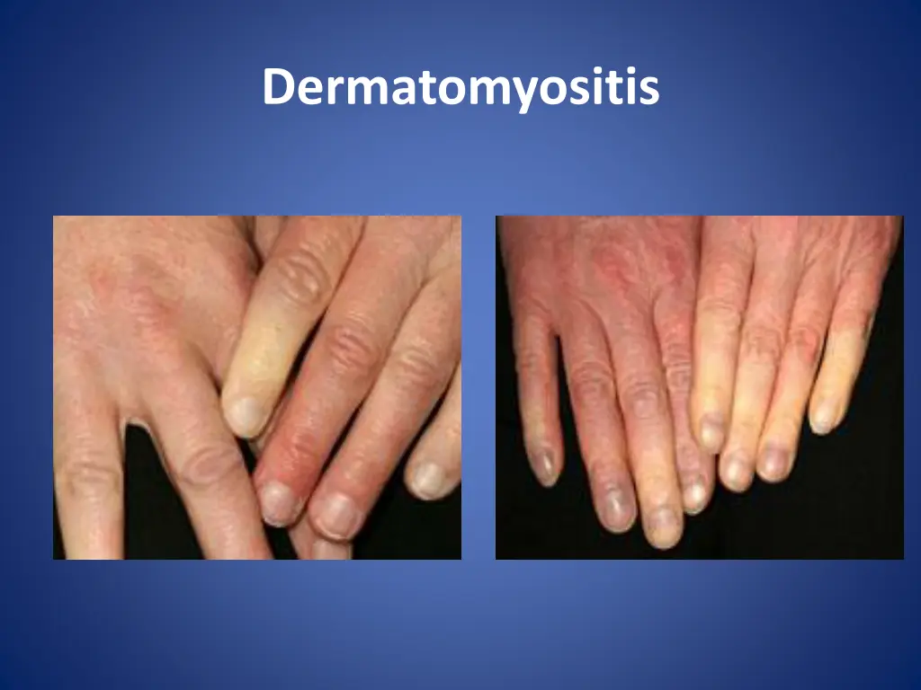 dermatomyositis 4