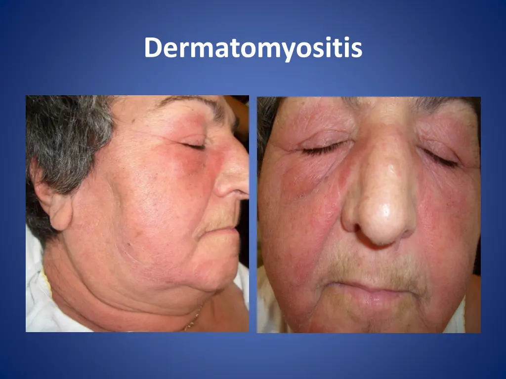 dermatomyositis 5