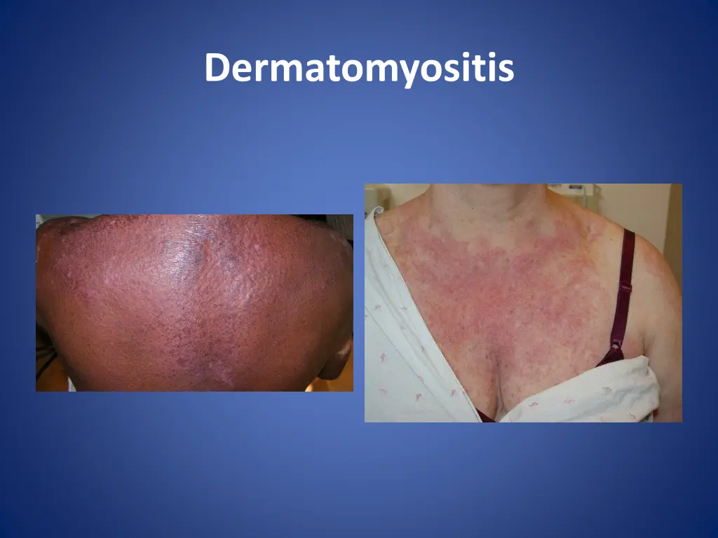 dermatomyositis 6