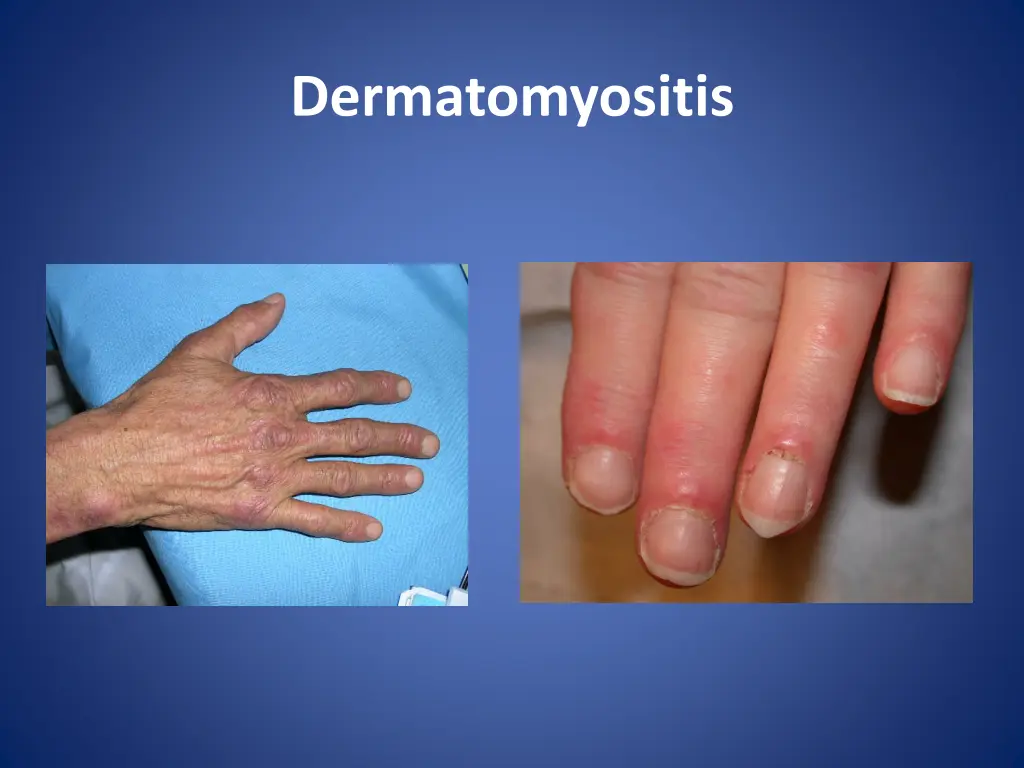 dermatomyositis 7