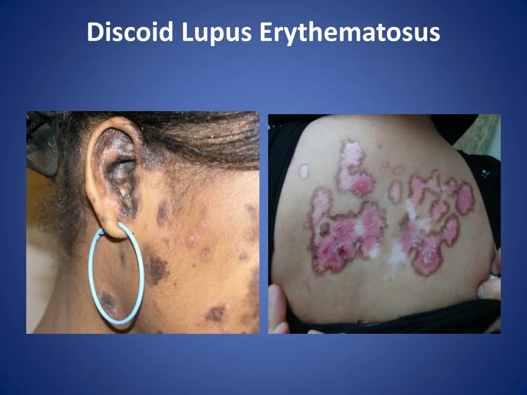 discoid lupus erythematosus 1