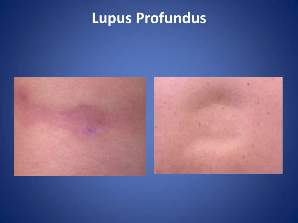 lupus profundus 2