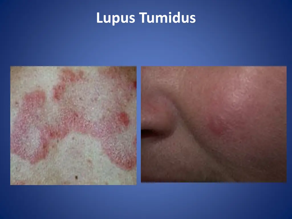 lupus tumidus 1