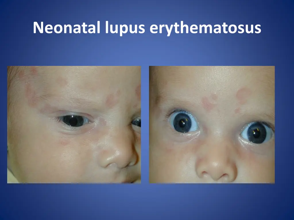 neonatal lupus erythematosus 1