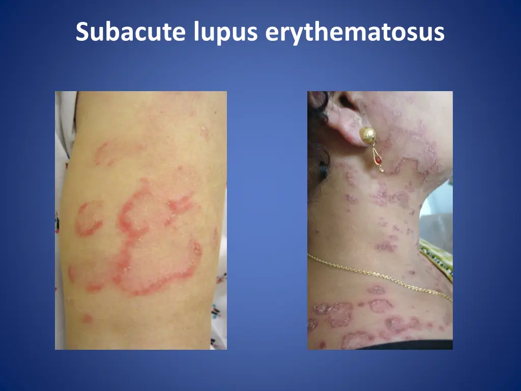 subacute lupus erythematosus 1