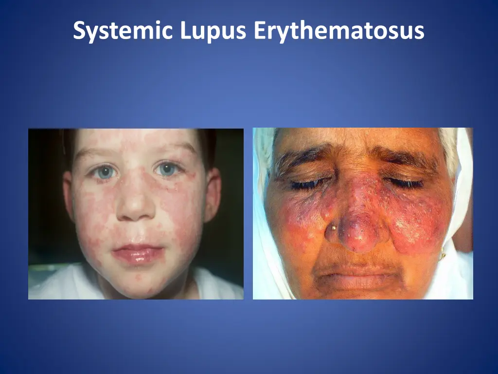 systemic lupus erythematosus 1