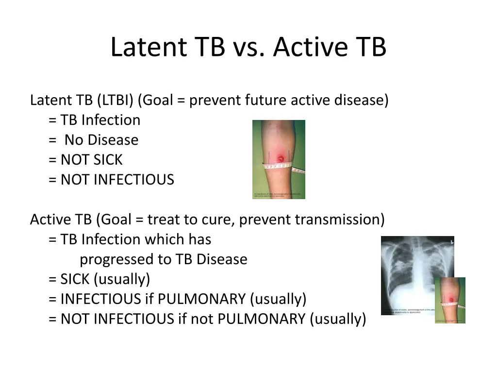 latent tb vs active tb