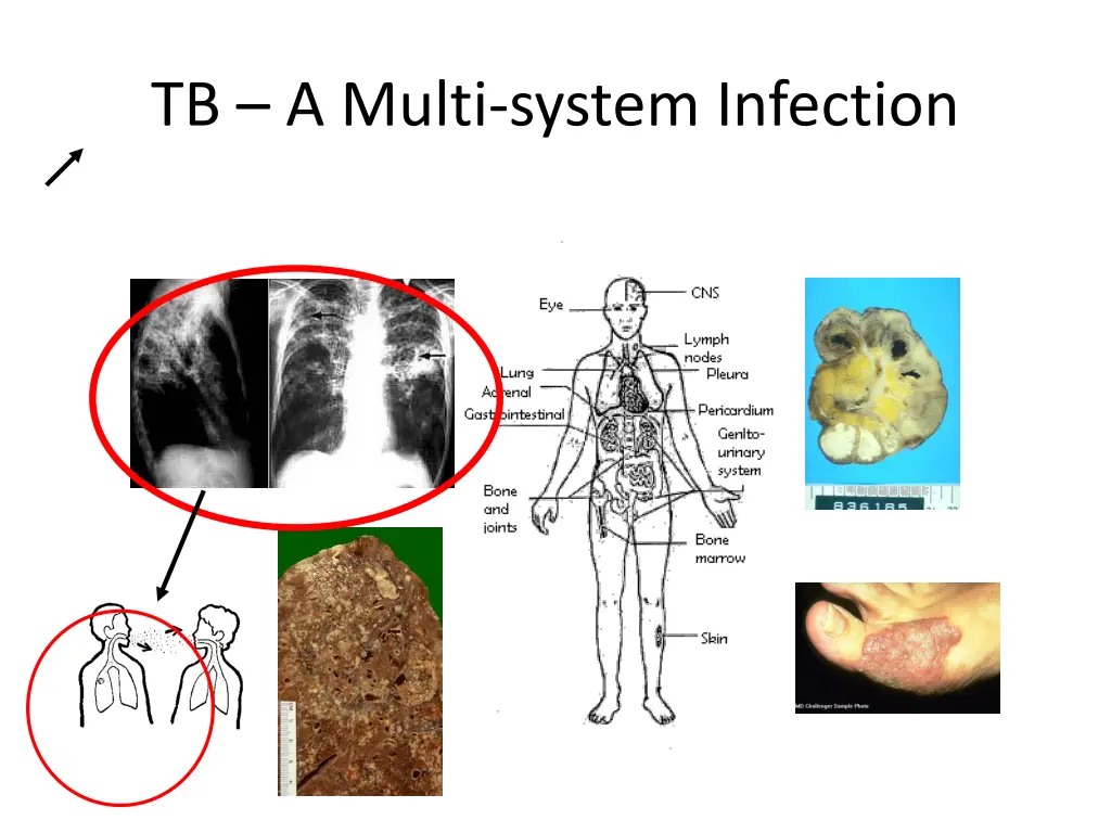 tb a multi system infection