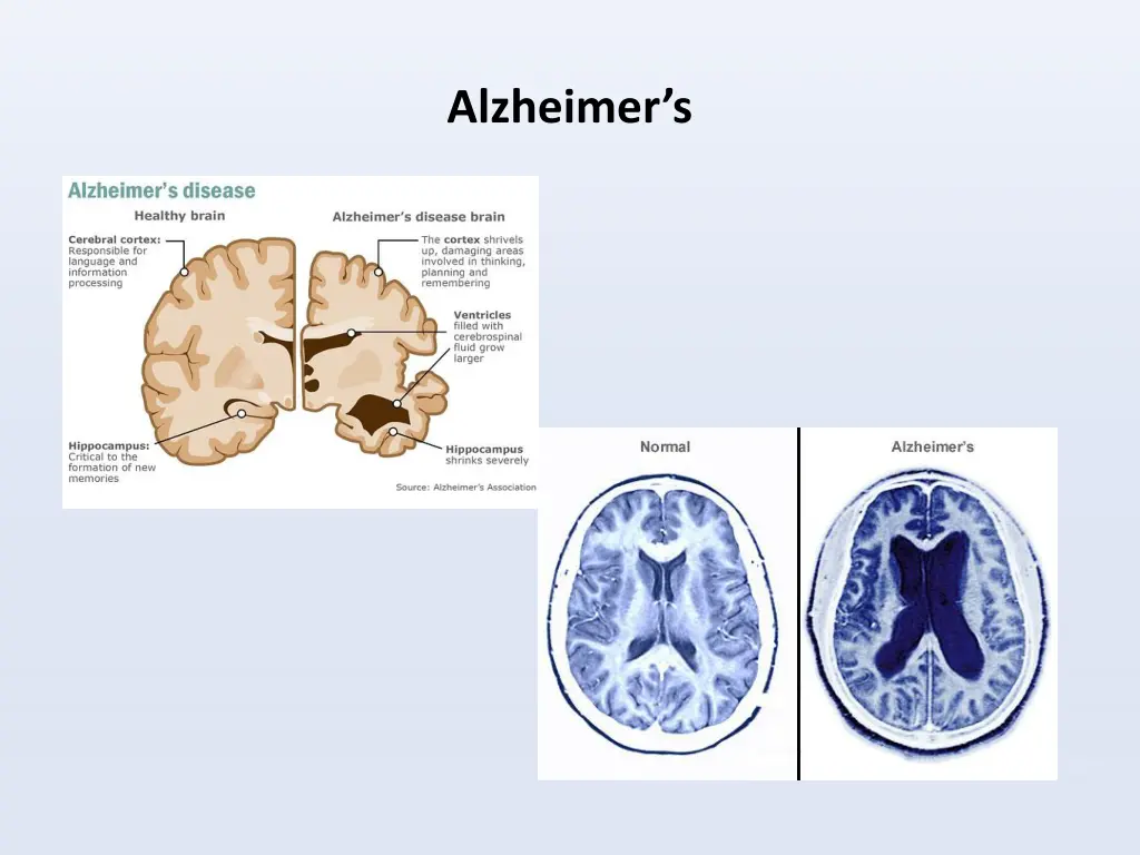 alzheimer s 1