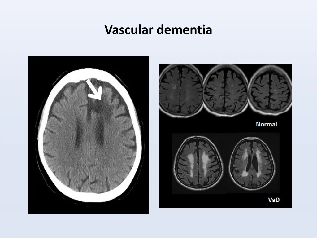 vascular dementia 1