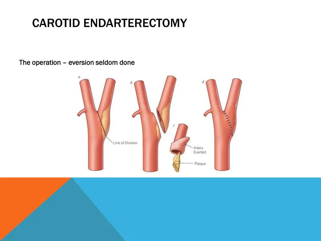 carotid endarterectomy 3