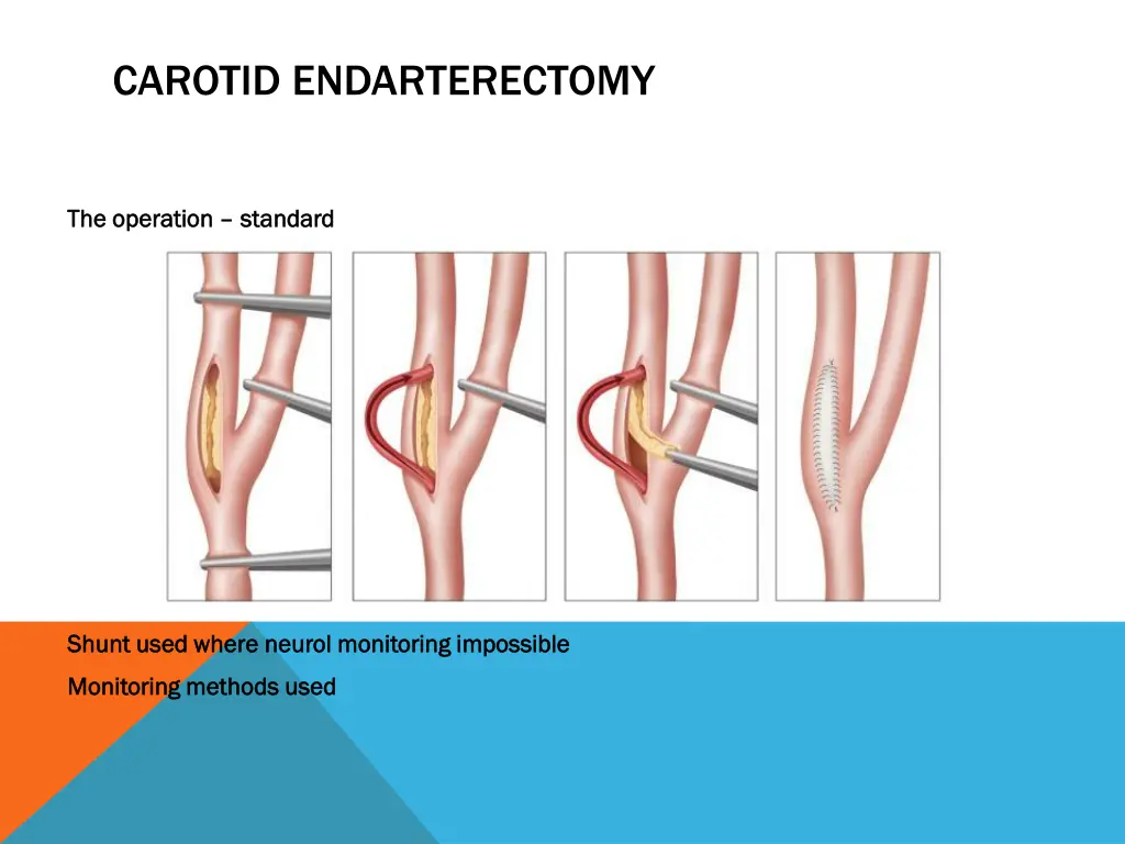 carotid endarterectomy 4