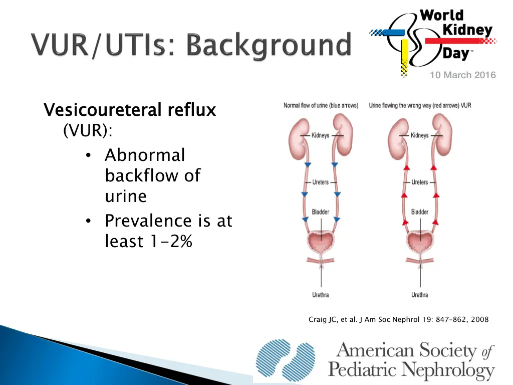 vesicoureteral vur abnormal backflow of urine