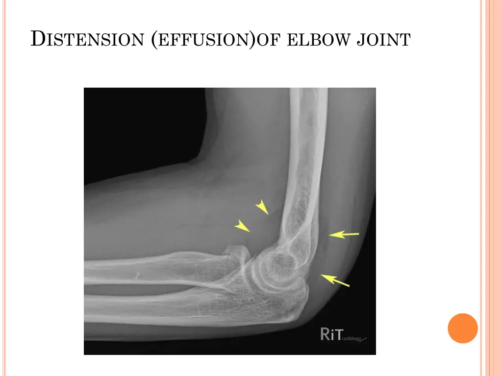 d istension effusion of elbow joint