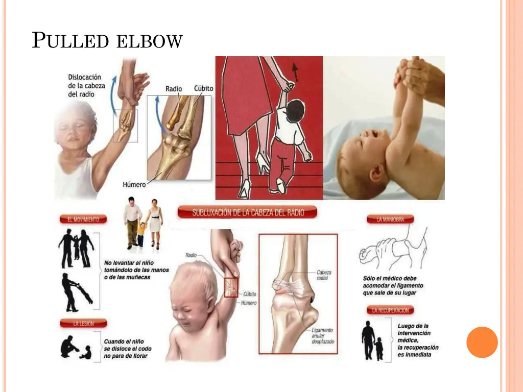 p ulled elbow