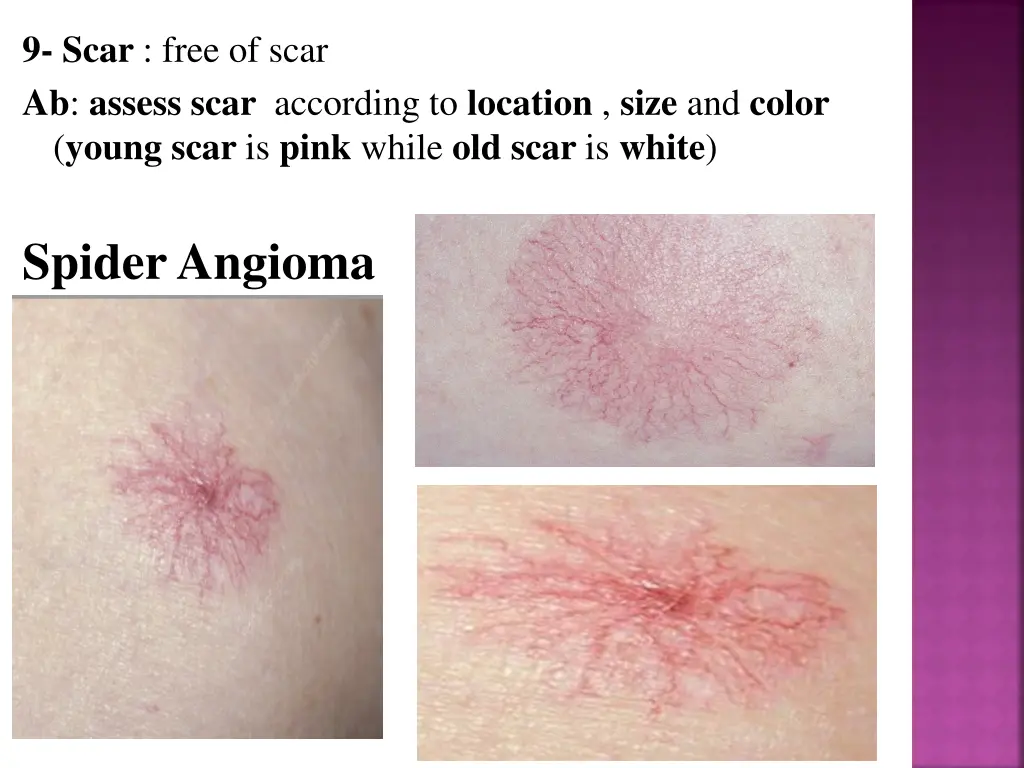 9 scar free of scar ab assess scar according