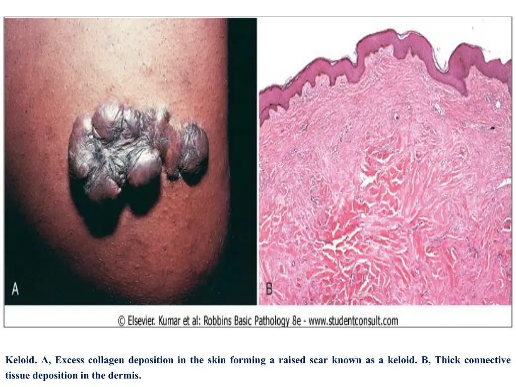 keloid a excess collagen deposition in the skin