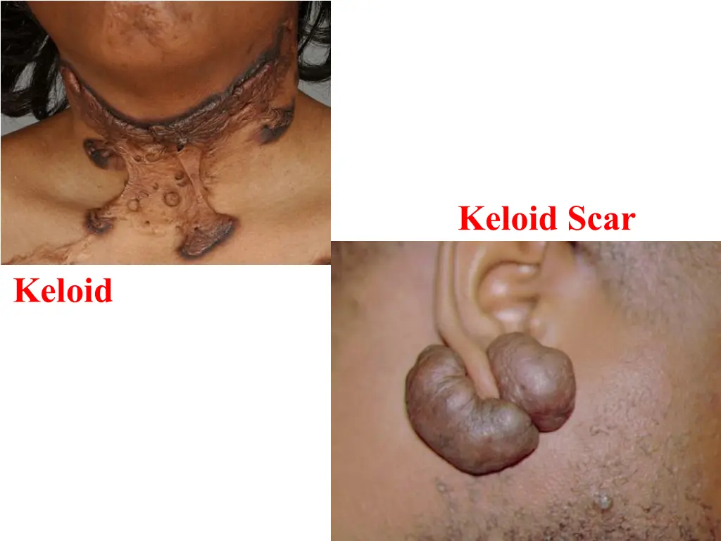 keloid scar