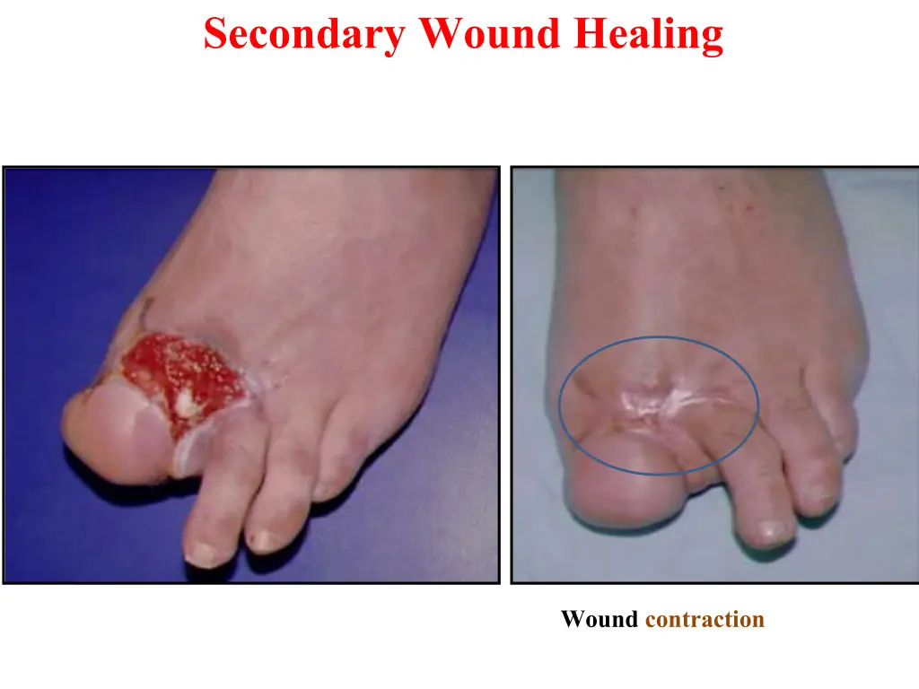 secondary wound healing