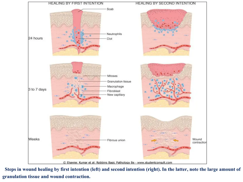 steps in wound healing by first intention left