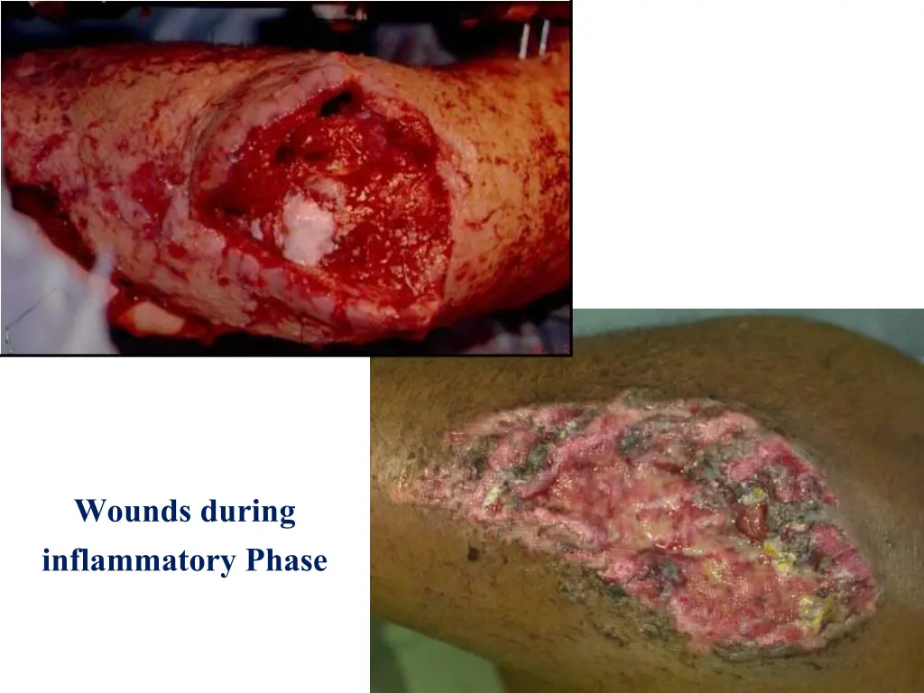 wounds during inflammatory phase