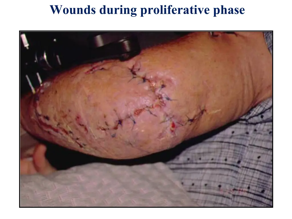 wounds during proliferative phase