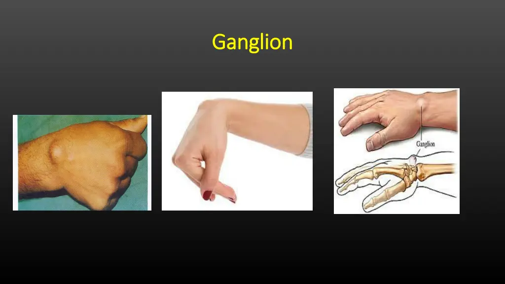 ganglion ganglion