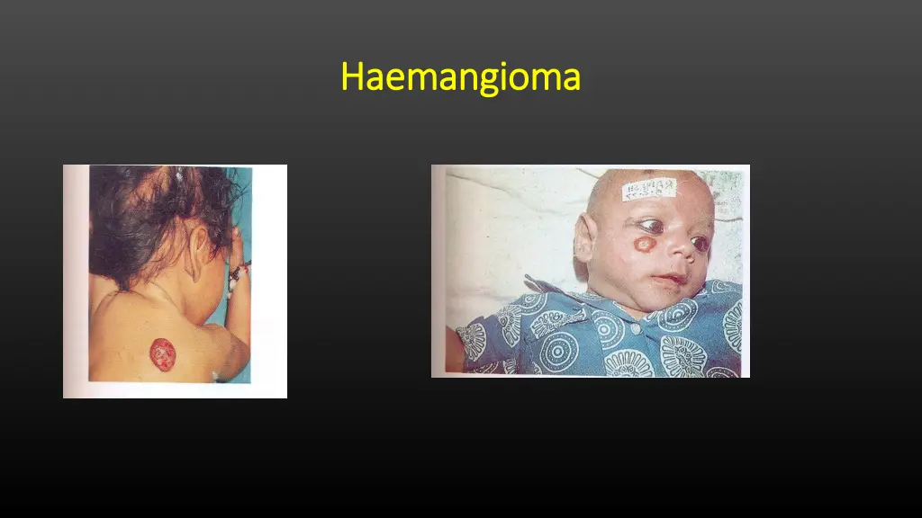 haemangioma haemangioma