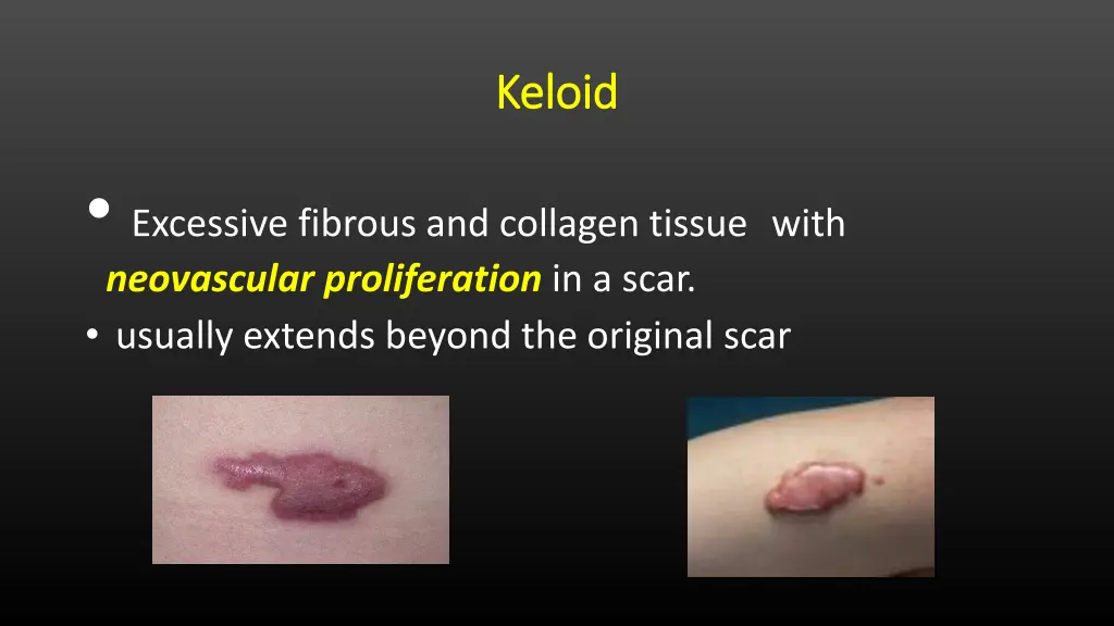 keloid keloid