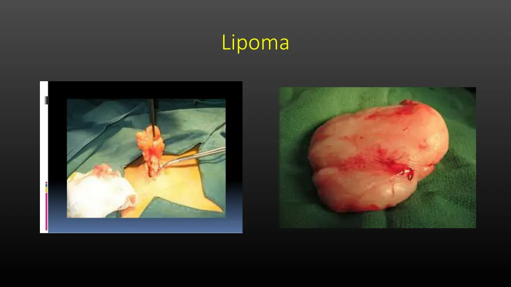 lipoma 1