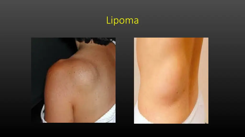 lipoma